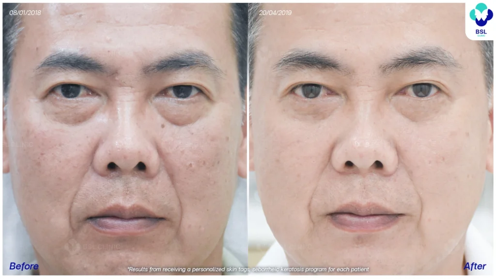 รีวิวรักษาไฝ