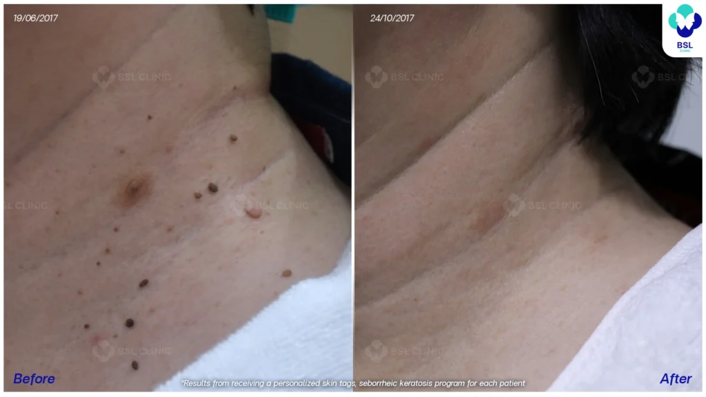 รีวิวรักษาไฝ รีวิวรักษาขี้แมลงวัน รักษาติ่งเนื้อ เลเซอร์ติ่งเนื้อ
