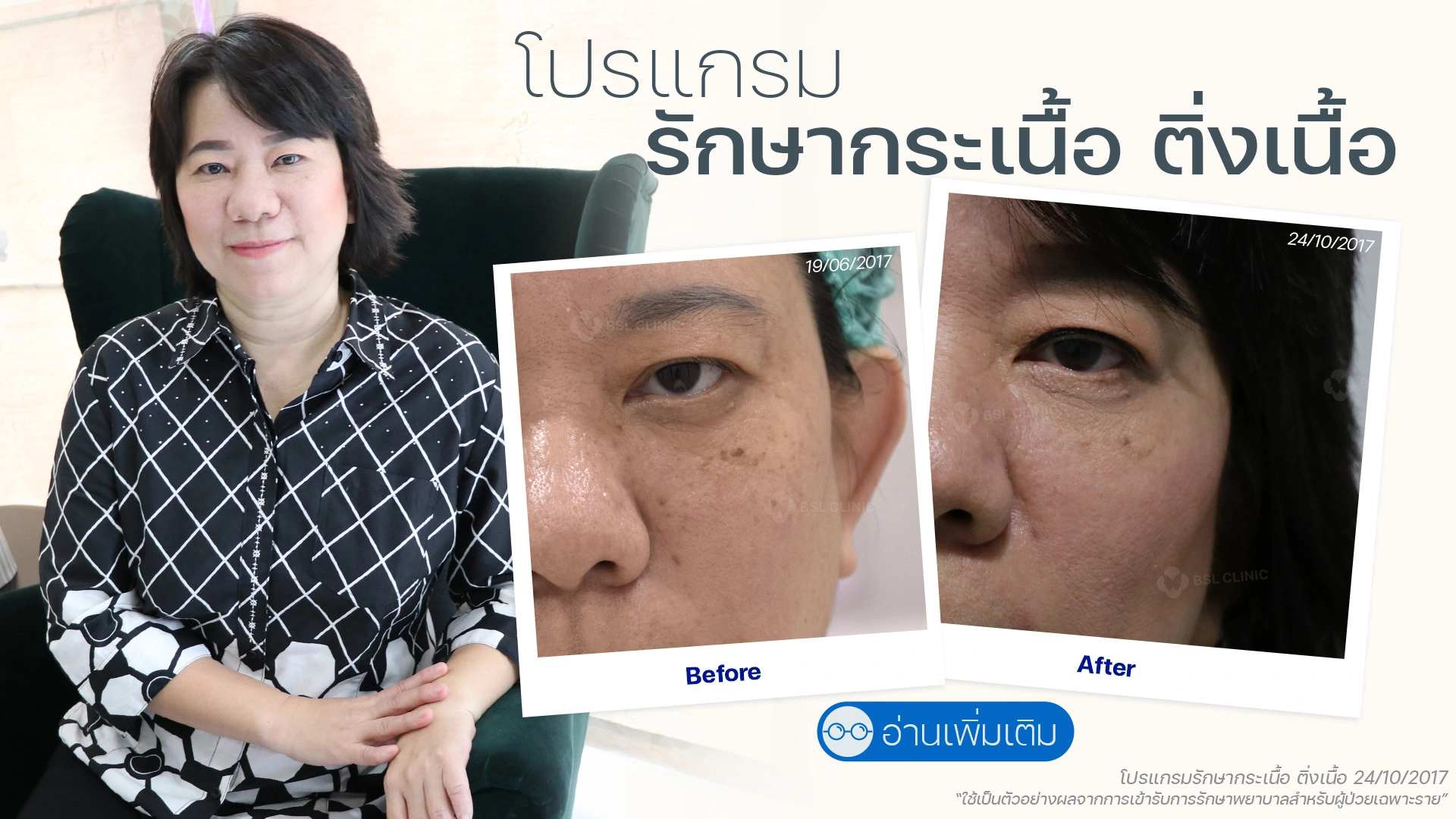 รักษาไฝที่คลินิกไหนดี