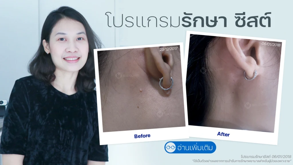 รักษาไฝที่คลินิกไหนดี