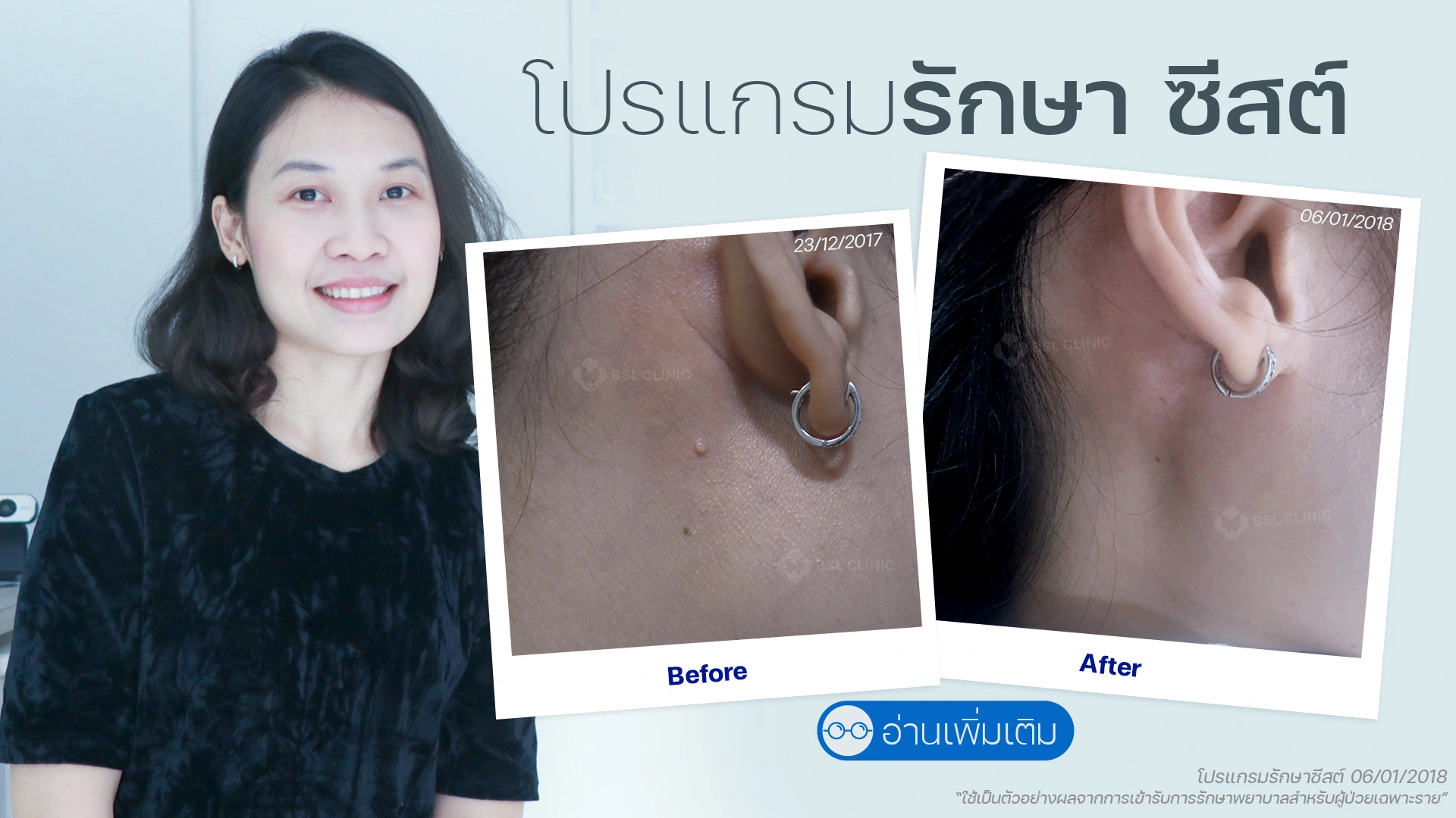รักษาไฝที่คลินิกไหนดี