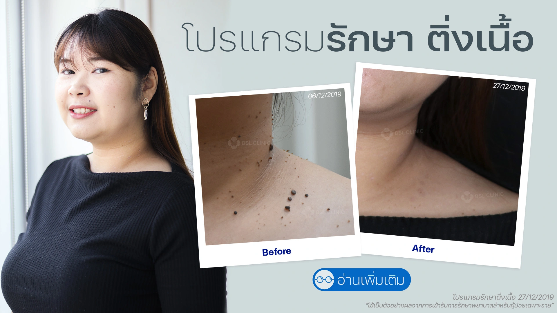 รักษาไฝที่คลินิกไหนดี