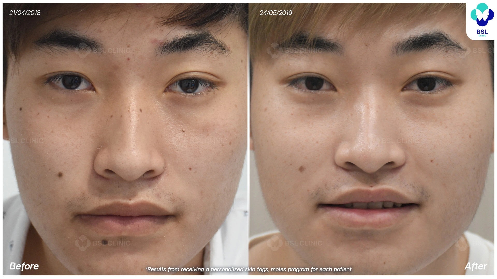 รักษาไฝ ติ่งเนื้อ ขี้แมลงวัน