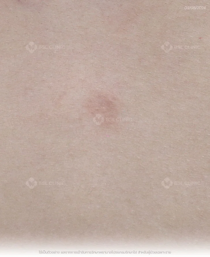 ผลการรักษาไฝ-ไฝที่หลัง-เลเซอร์ไฝ-จี้ไฝ-After