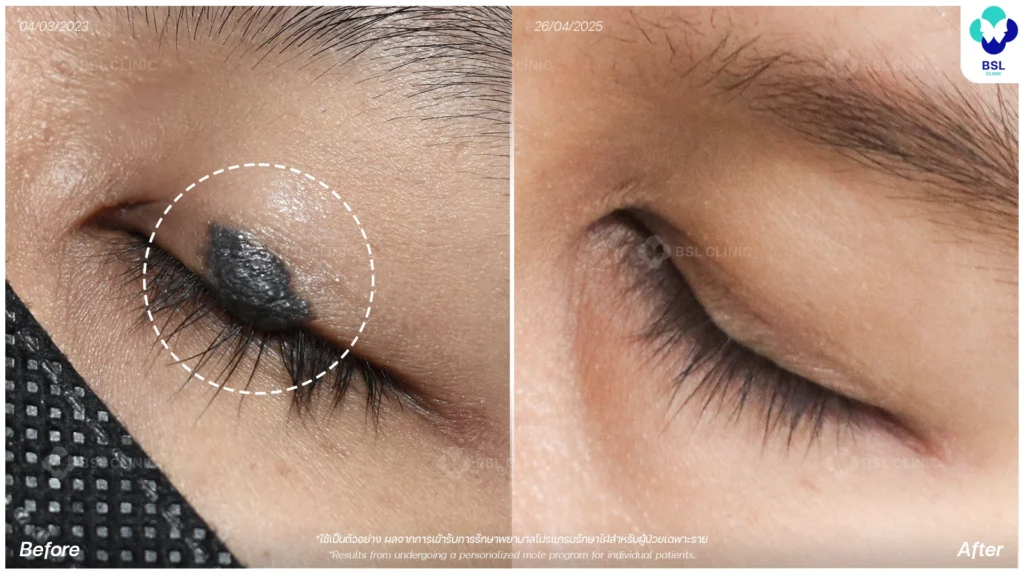 รีวิว รักษาไฝ ไฝที่ตา ไฝนูน เลเซอร์ไฝ